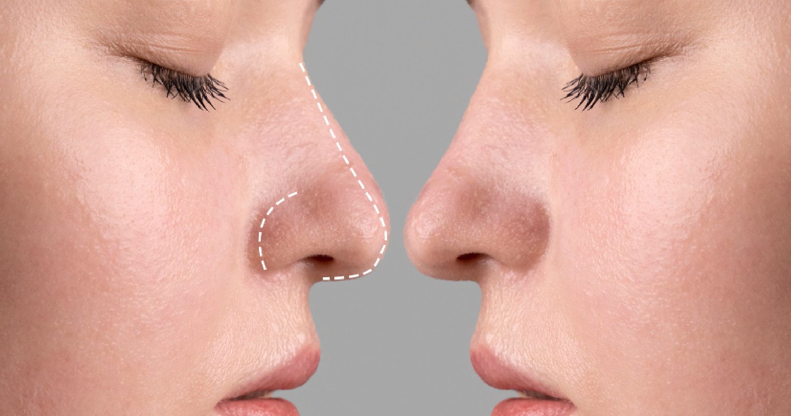 Fillers in Bangalore